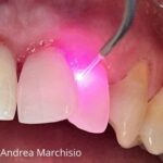 trattamento laser per parodontite luce rosa su dente