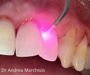 trattamento laser per parodontite luce rosa su dente