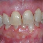 paziente con parodontite primo piano dei denti e delle gengive per vedere cos'è la parodontite