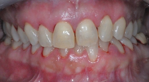 paziente con parodontite primo piano dei denti e delle gengive per vedere cos'è la parodontite