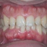 bocca colpita da parodontite, visita e diagnosi