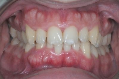 bocca colpita da parodontite, visita e diagnosi