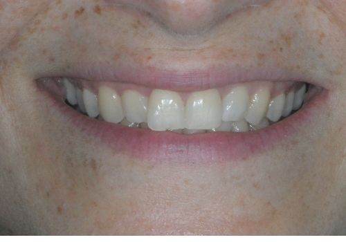 immagine denti prima del trattamento di sbiancamento