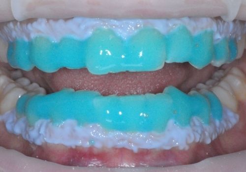 applicazione del gel sbiancante sui denti