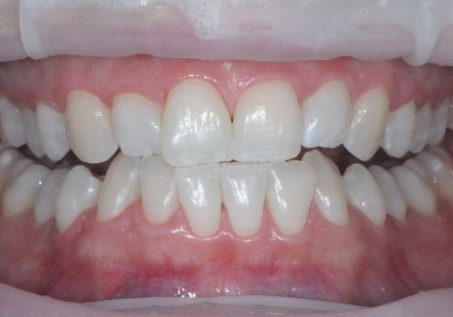 effetto dello sbiancamento sui denti a fine trattamento