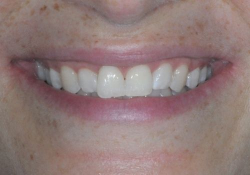 immagine denti dopo il trattamento di sbiancamento laser professionale