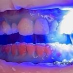 primo piano denti durante procedura di sbiancamento con led