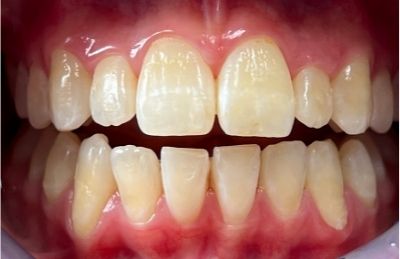 white spot su denti ingialliti e macchiati