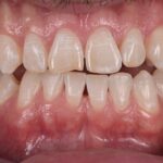 fluorosi - macchie bianche sui denti