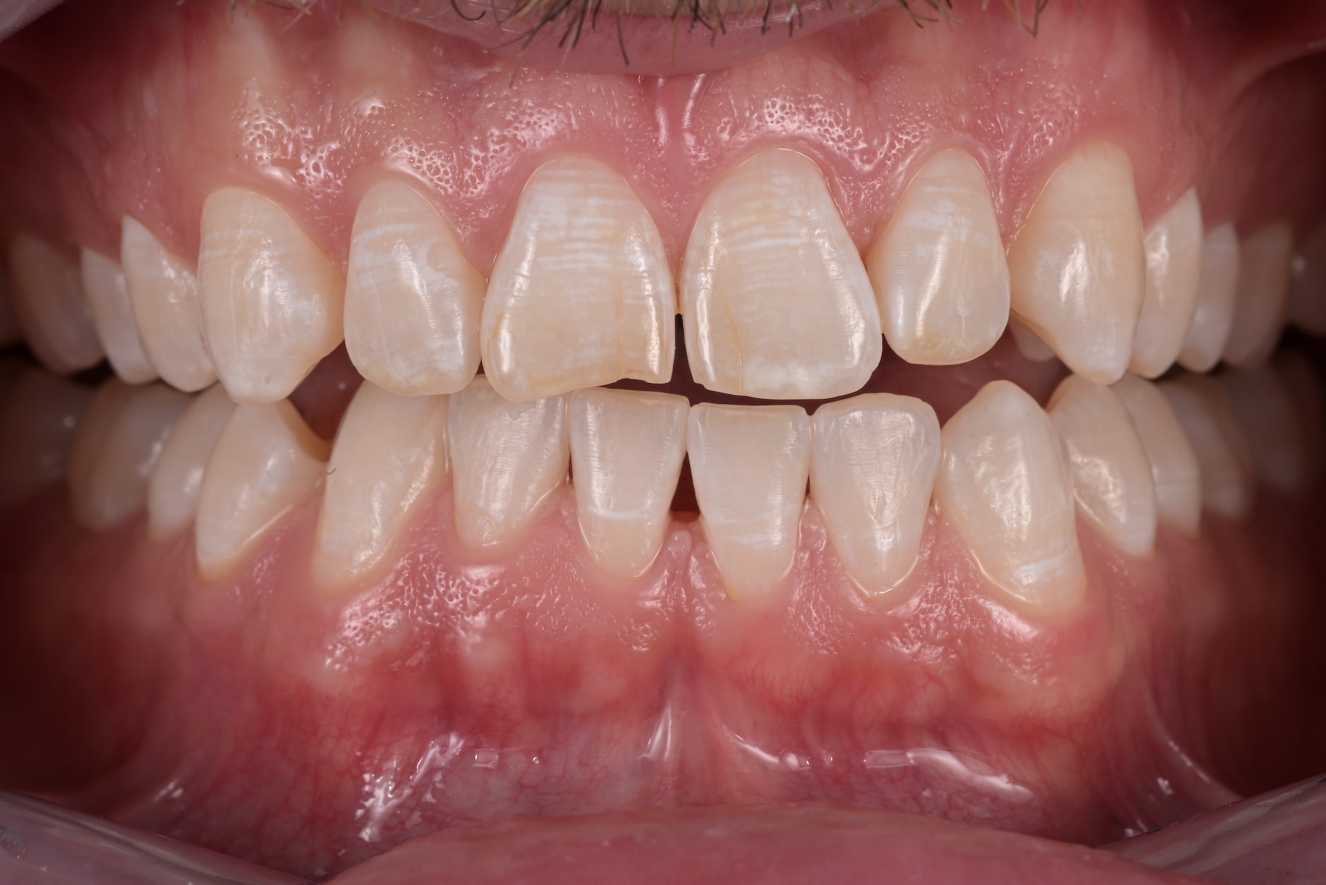 fluorosi - macchie bianche sui denti
