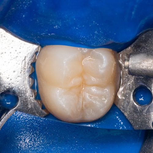 dente molare di bambino con solchi aperti