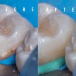 carie dentale prima e dopo l'infiltrazione di resina