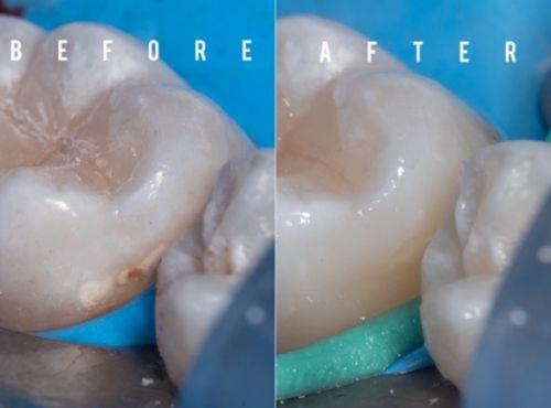 carie dentale prima e dopo l'infiltrazione di resina