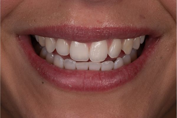 sorriso di donna con difetto dello smalto dei denti dopo il trattamento