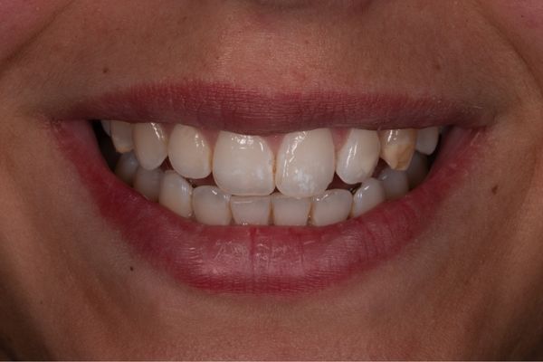 sorriso di donna con difetto dello smalto dei denti prima del trattamento