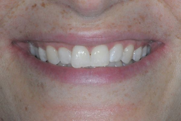 sorriso di donna dopo lo sbiancamento dentale