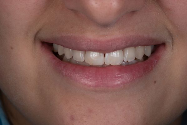 sorriso di donna dopo lo sbiancamento dentale