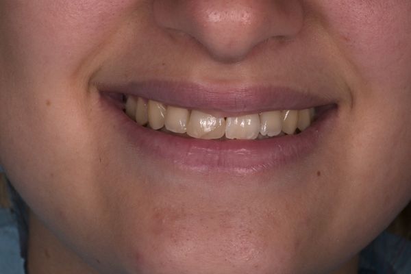sorriso di donna prima dello sbiancamento dentale